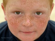 freckles2